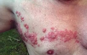 Illustration for article titled obat herpes
